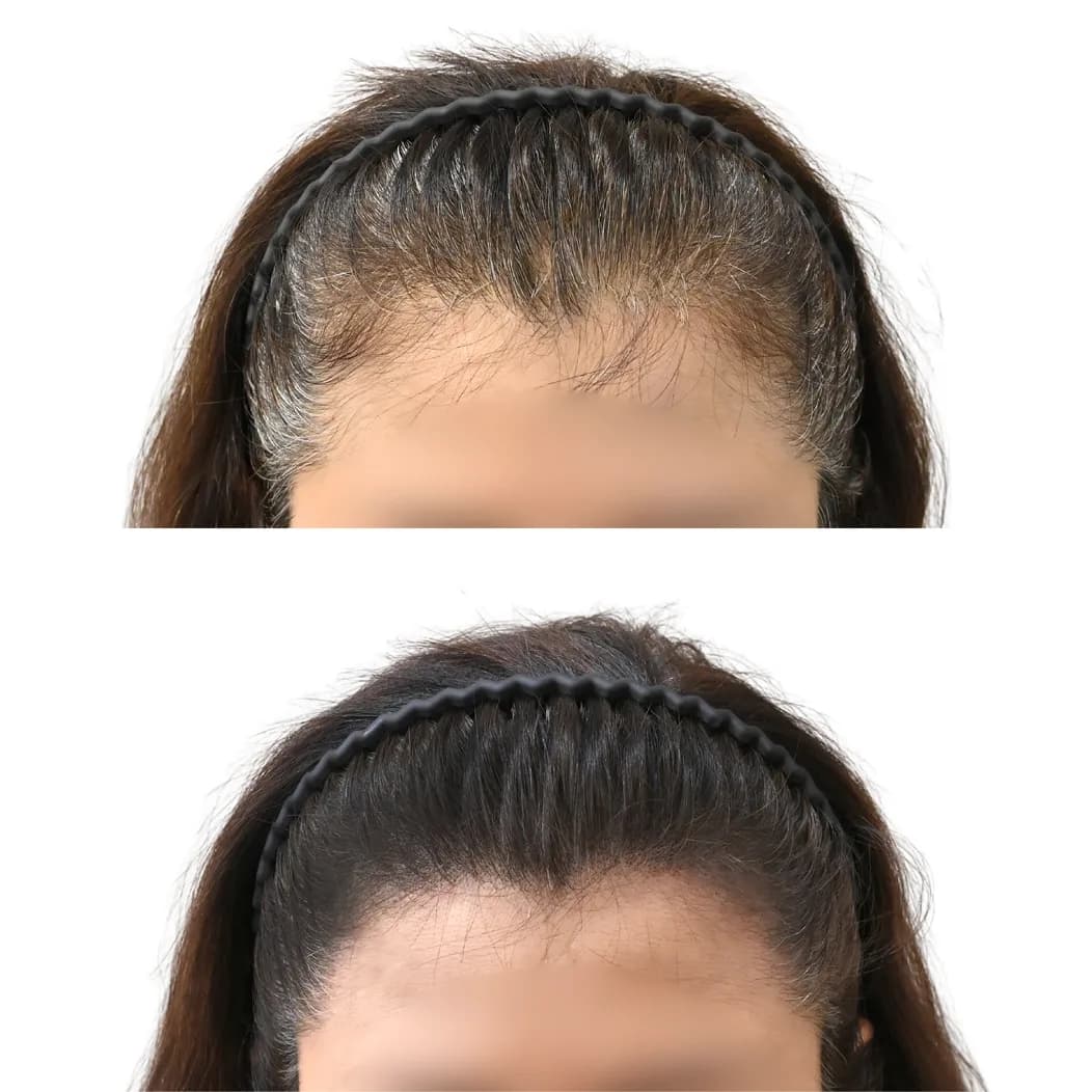미두스칼프 두피커버 전후 사진 1