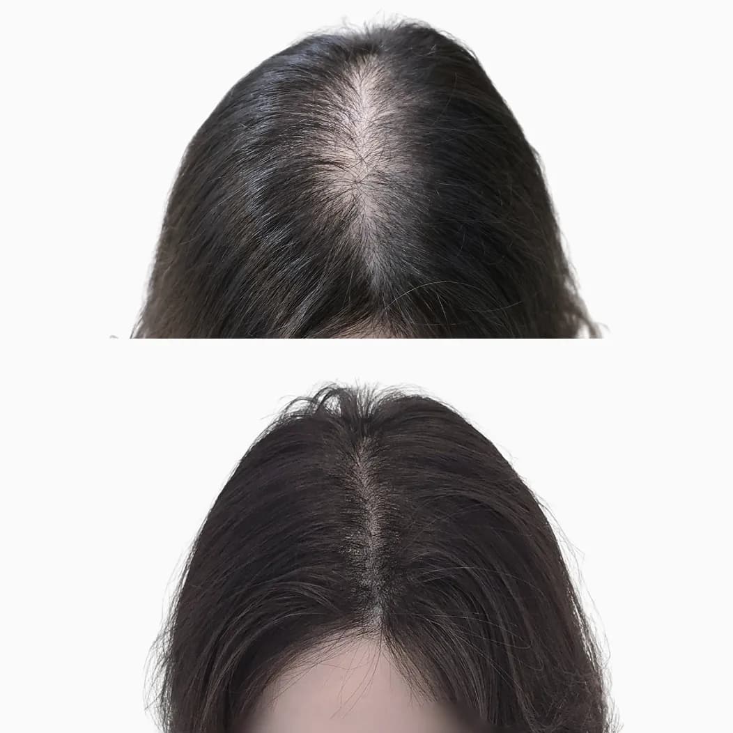 미두스칼프 두피커버 전후 사진 4