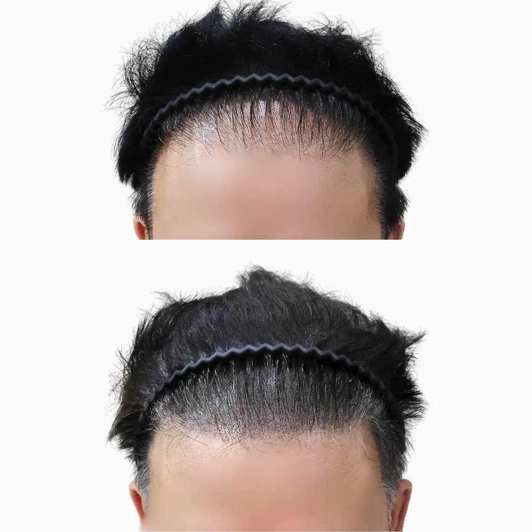 미두스칼프 두피커버 전후 사진 5