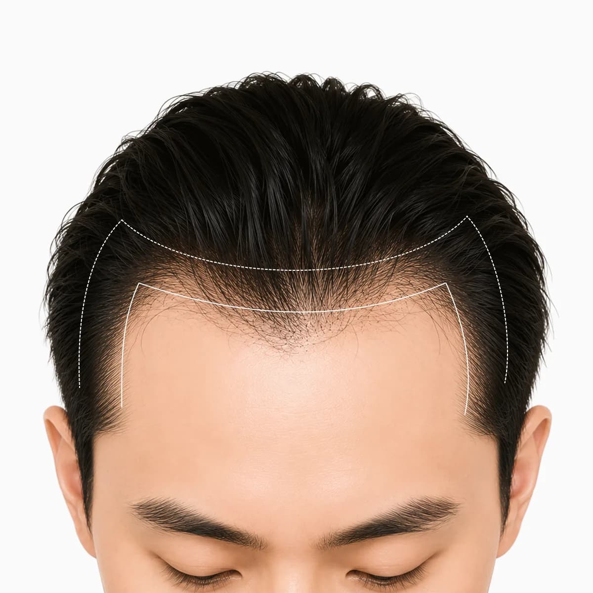 남성 헤어라인 이미지