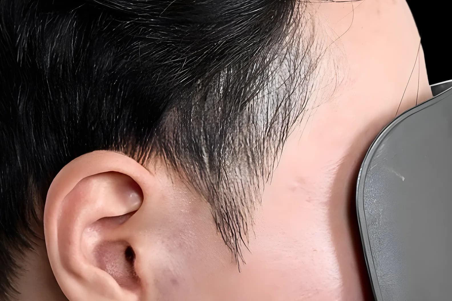 미두스칼프 남성 구렛나루 시술 전 이미지
