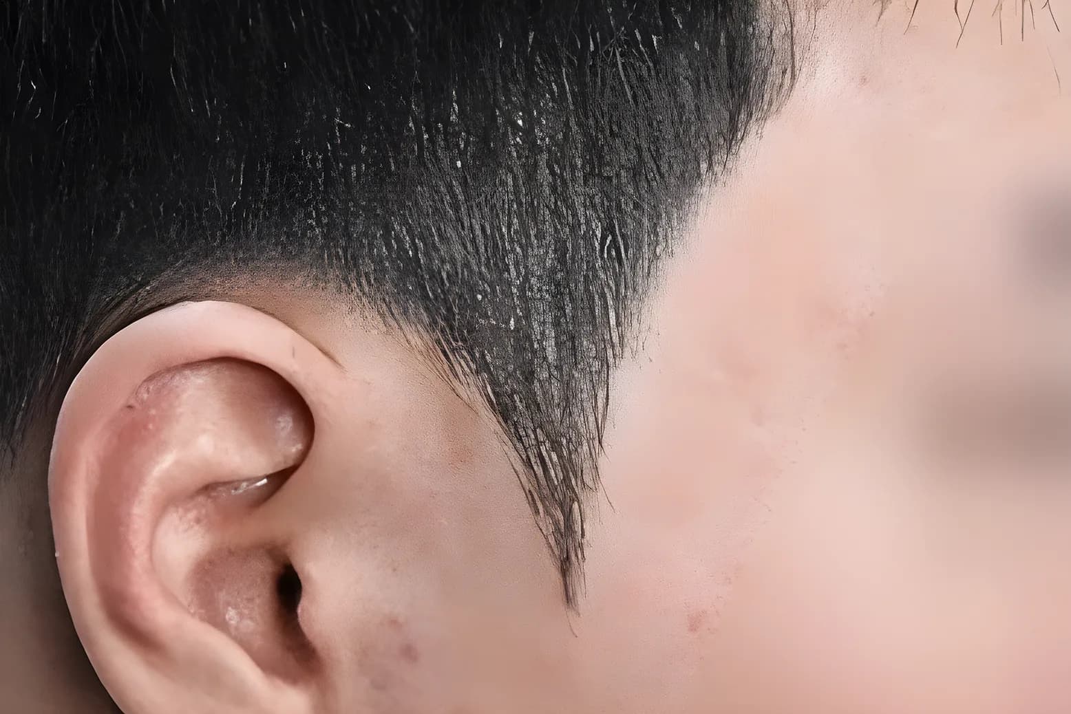 미두스칼프 남성 구렛나루 시술 후 이미지