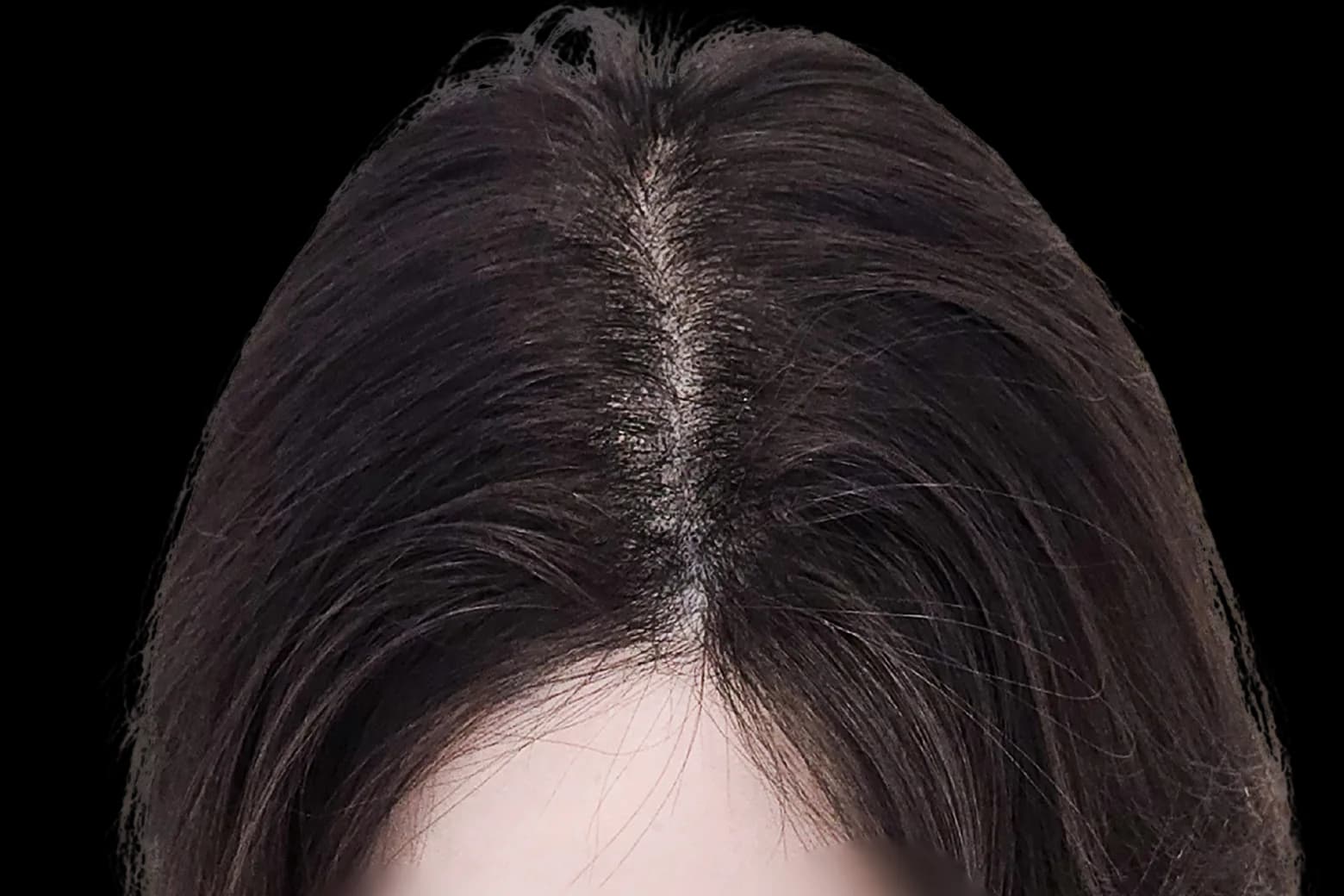미두스칼프 여성 가르마 · 정수리 시술 후 이미지